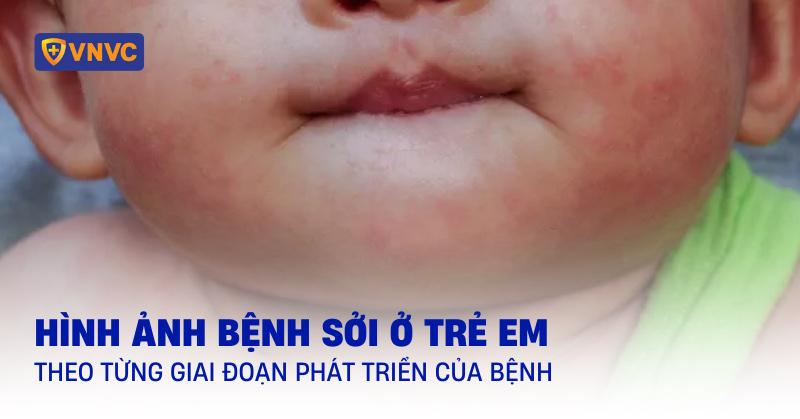 Hình ảnh mụn đầu đinh ở giai đoạn khởi phát, dấu hiệu sưng đỏ ban đầu